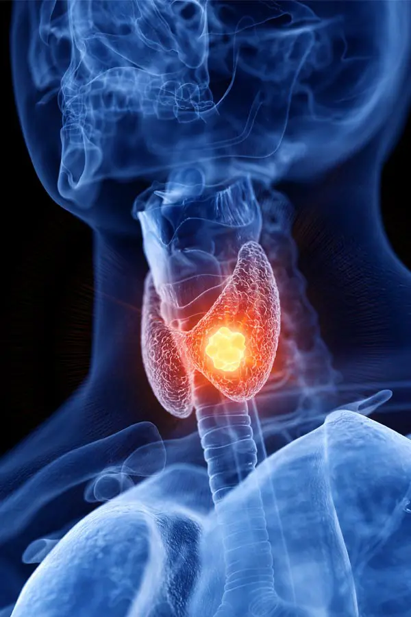 Thyroid-Imbalance-Treatment A 3D illustration of an x-ray of a human neck, highlighting the thyroid. Get help with thyroid imbalance from Dr. Robert Powers of Eternal Vitality Orlando in Orlando.