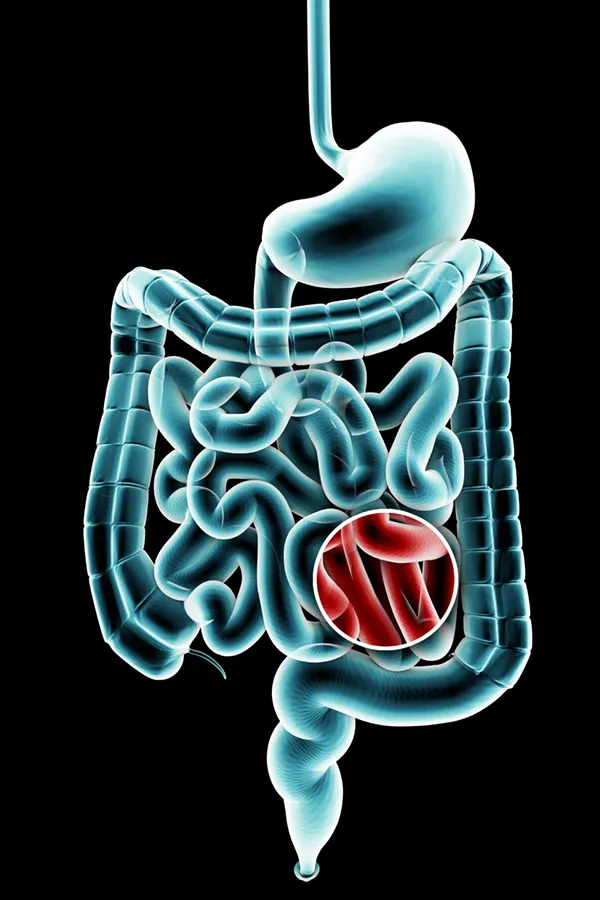 Ulcerative-Colitis-Treatment 3D illustration of the digestive system in blue tones, with an area of discomfort in red tones. Get treatment for Ulcerative Colitis from Dr. Robert Powers of Eternal Vitality Orlando in Orlando.